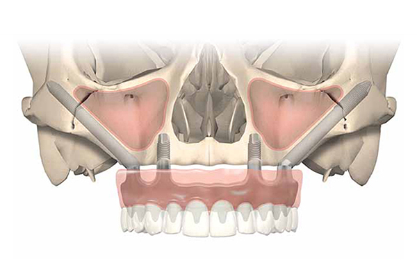 What-are-Zygomatic-Implants